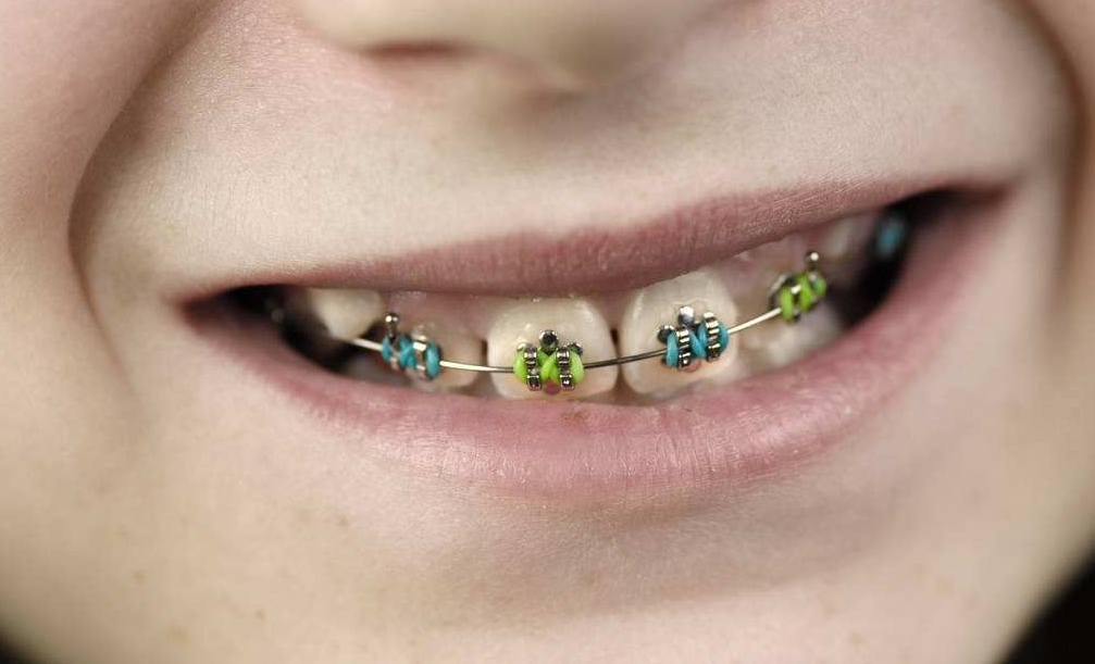 儿童牙齿畸形矫正方式有哪些?